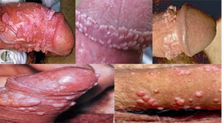 Illustration for article titled Cara Menghilangkan benjolan Di Kepala Penis